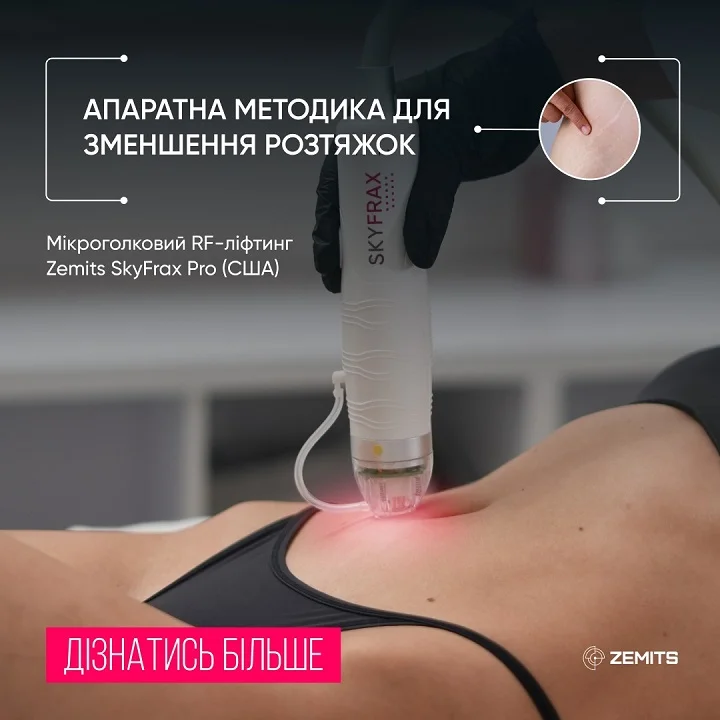 Мікроголковий RF ліфтинг. Позбуваємось зморшок та розтяжок. ZEMITS. Львів.