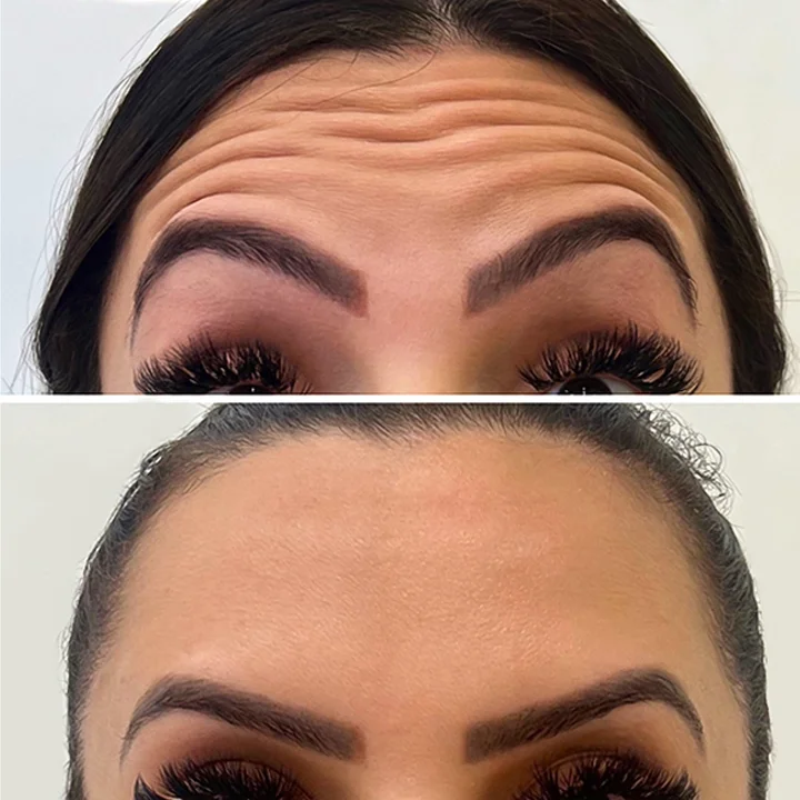 Ін'єкційна косметологія. Уколи краси. Botox. Львів.