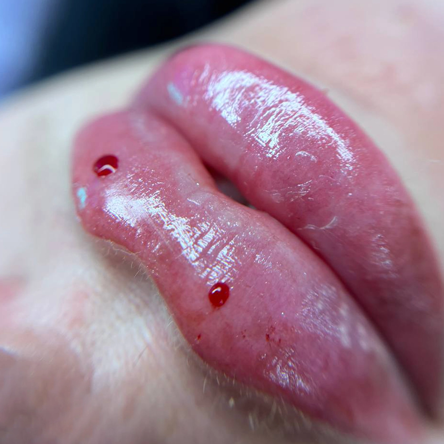 Збільшення губ у Львові