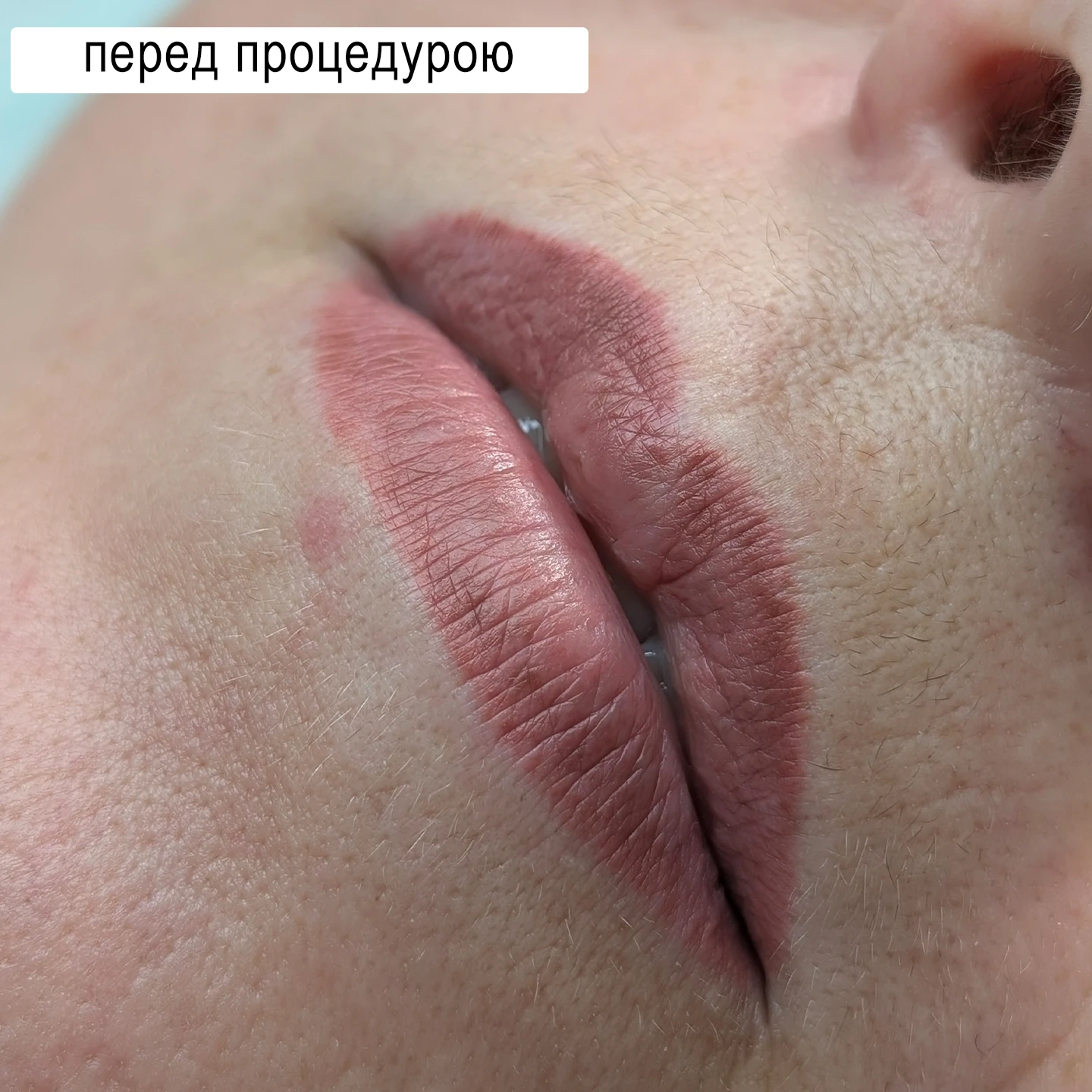 Перед аугментацією губ: стан до процедури