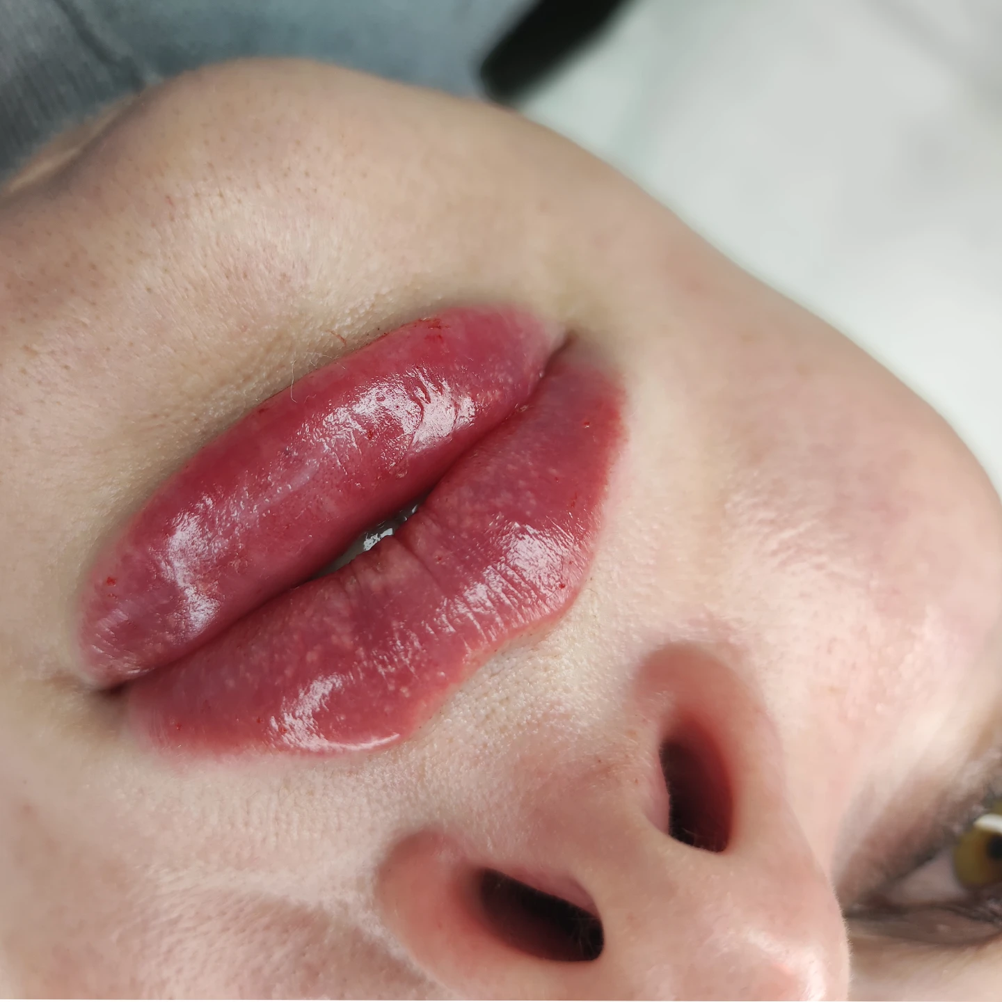 Аугментація губ: косметолог Наталія Філь