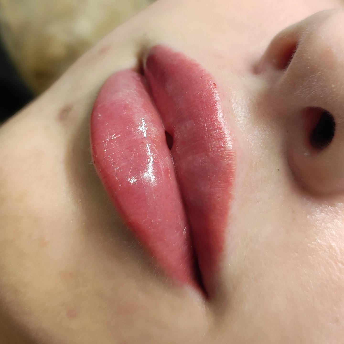 Ін'єкції губ: корекція форми