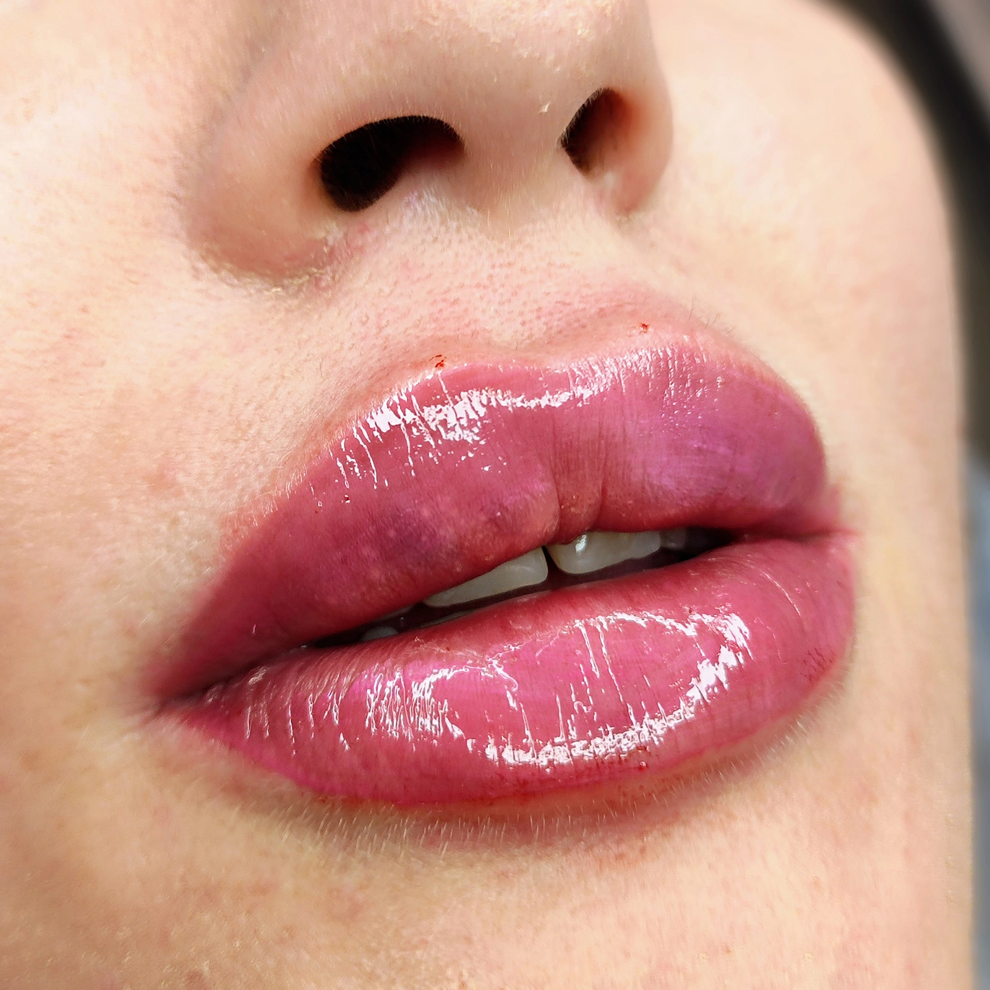 Збільшення об'єму губ у Львові