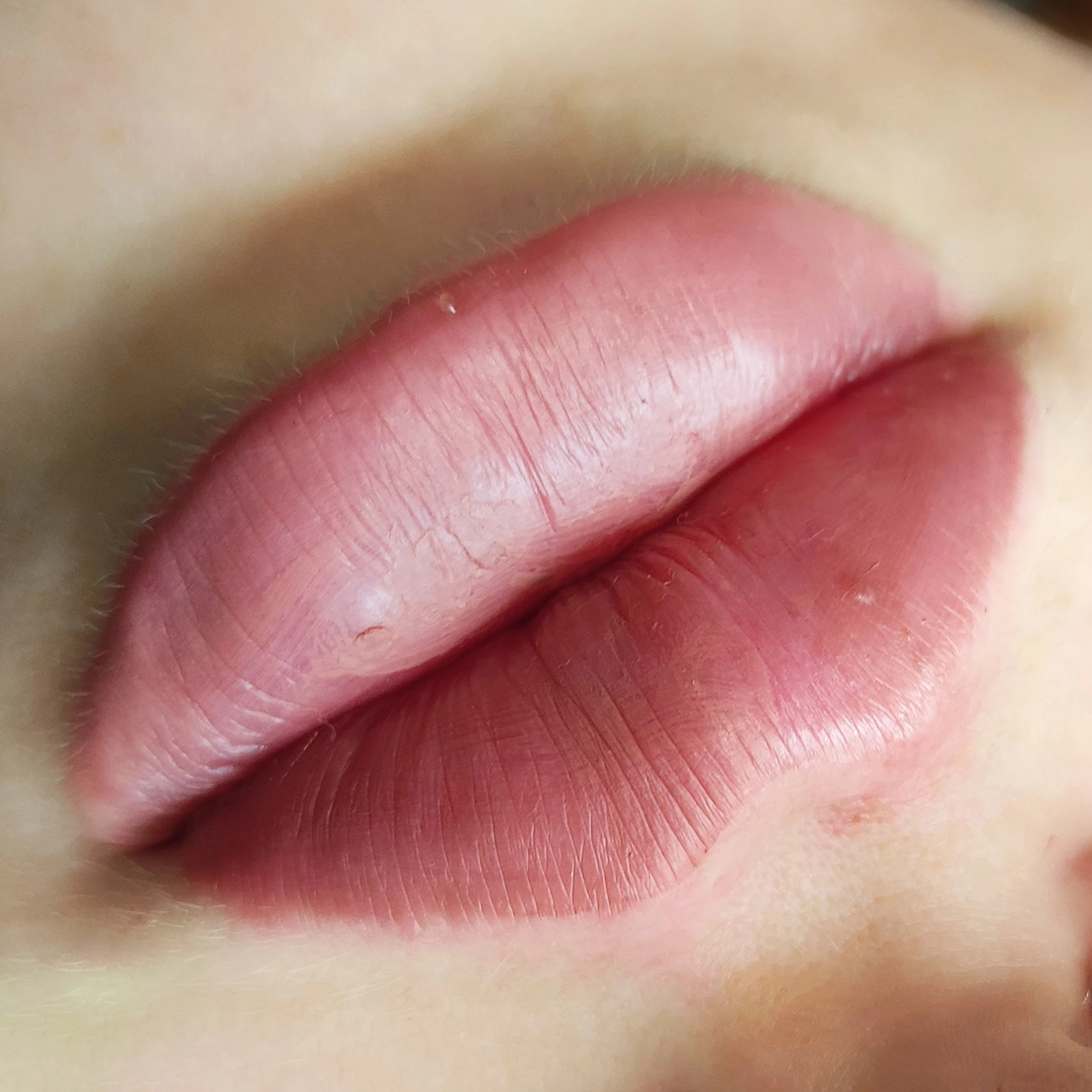 Аугментація губ у Львові