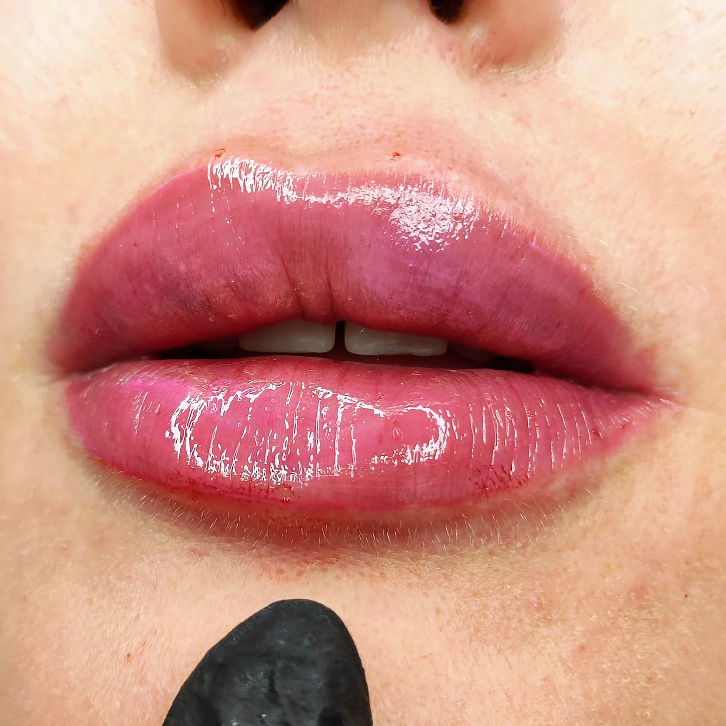 Результат збільшення губ