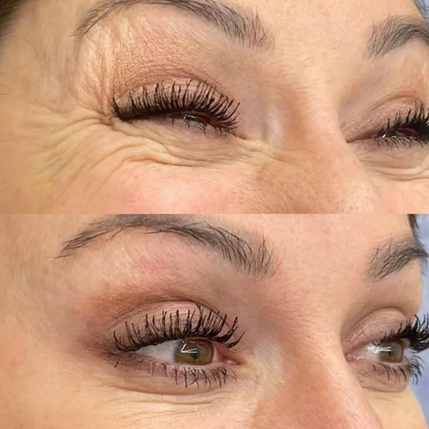 Ботокс. Ботулінотерапія. Львів