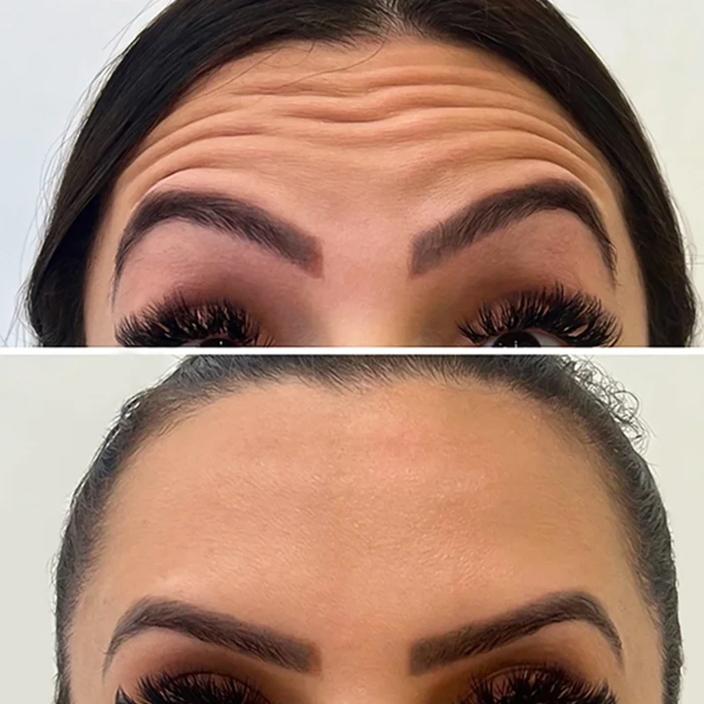 Розгладження зморшок. Омолодження обличчя. Львів.