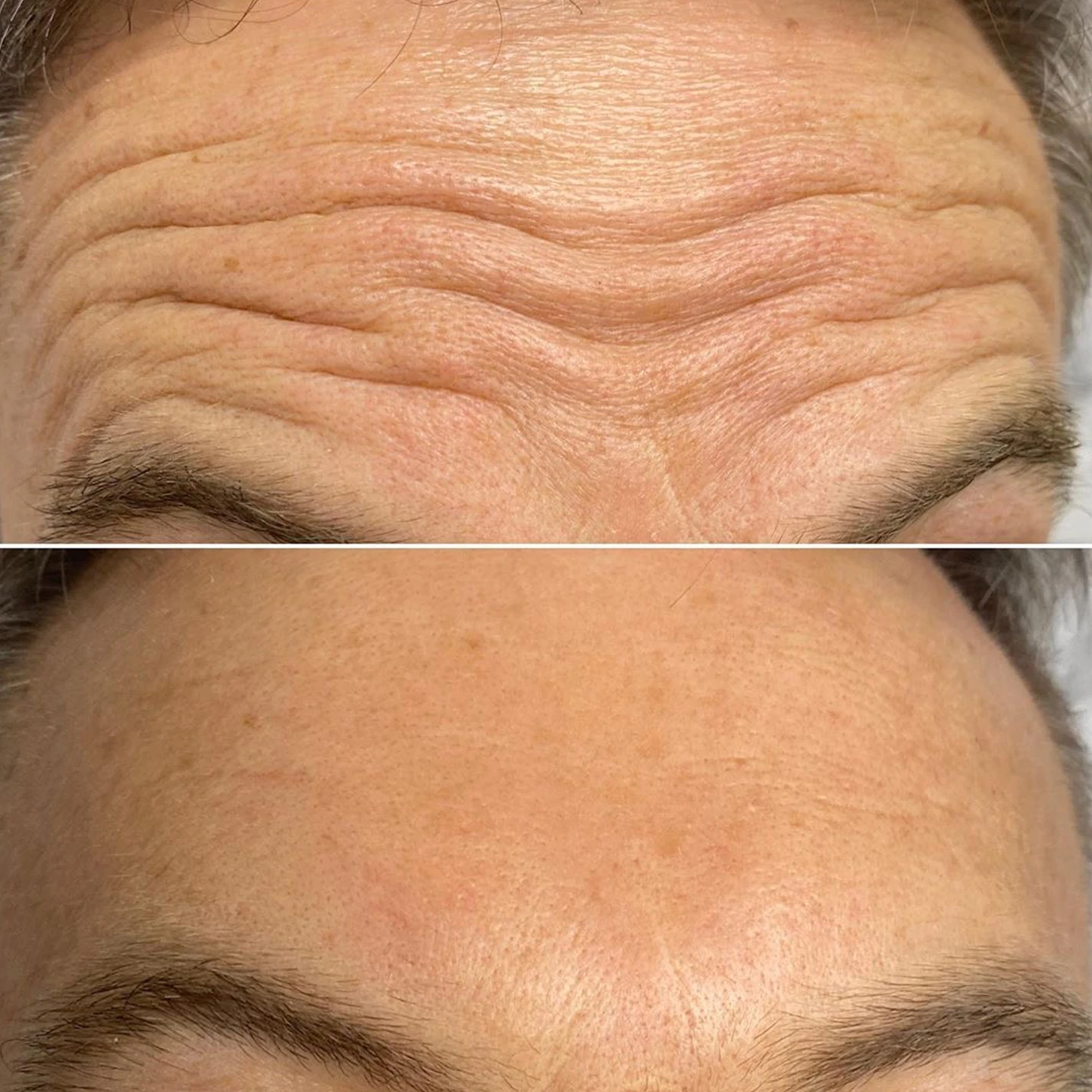 Уколи краси. Ін'єкційна косметологія. БОТОКС. Львів.