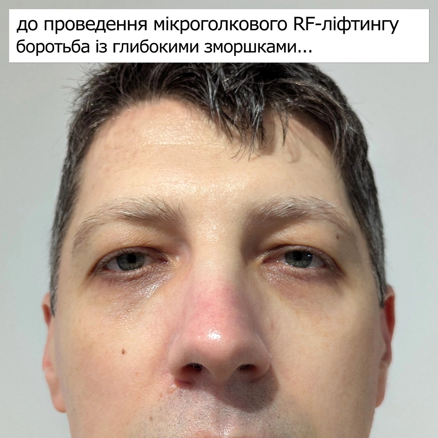 Стан шкіри до процедури мікроголкового RF-ліфтингу