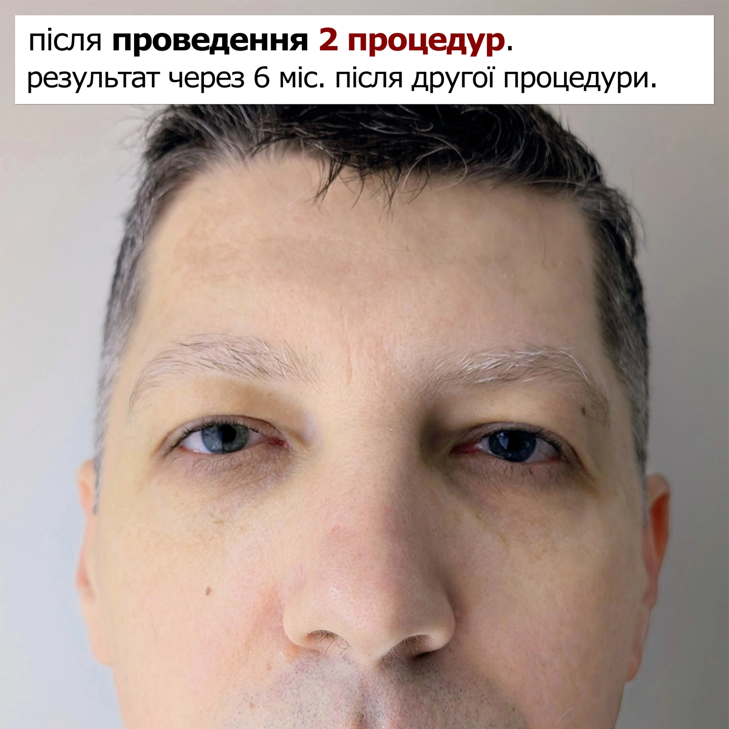 Ефект після процедури мікроголкового рф ліфтингу