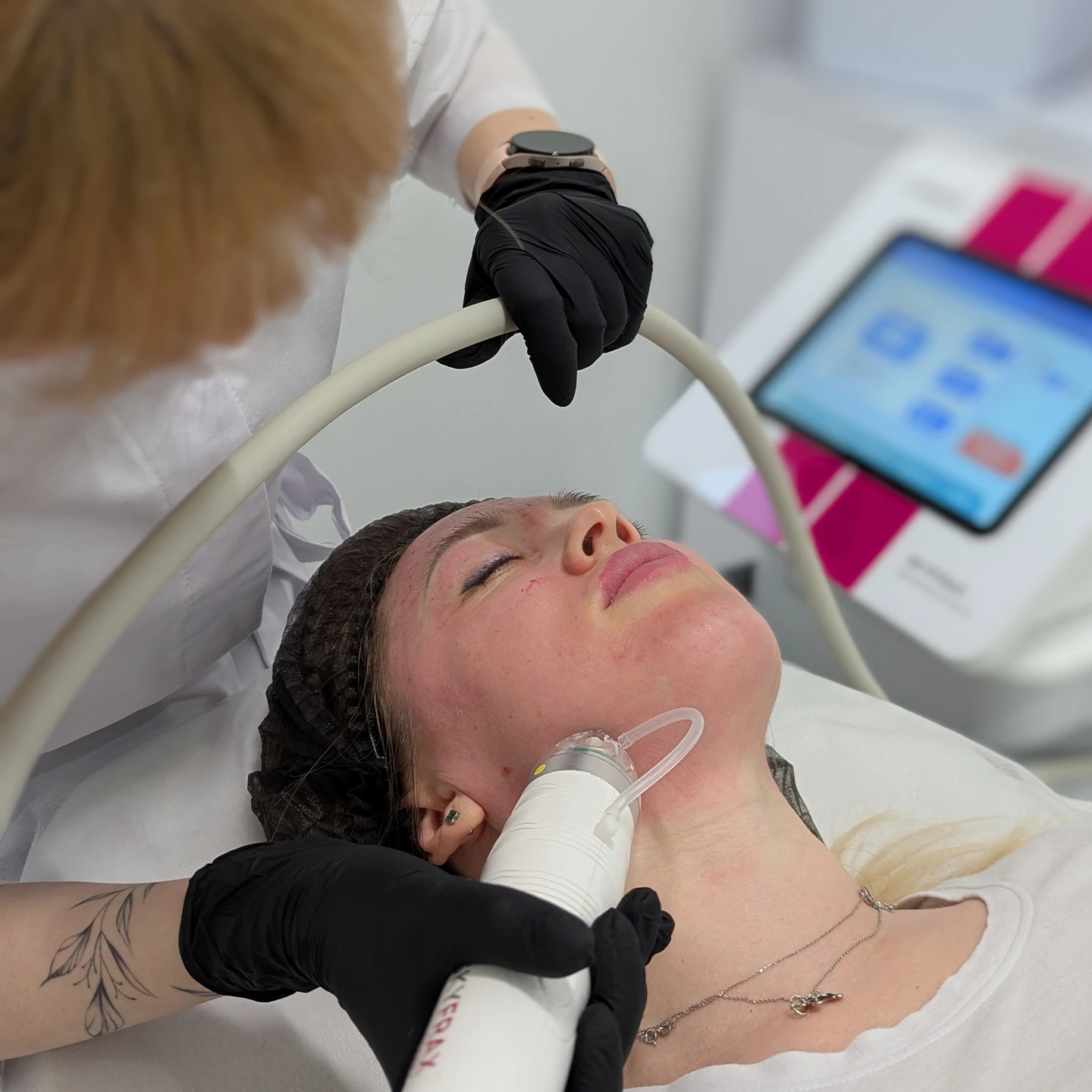 мікроголковий рф ліфтинг в студії Наталії Філь