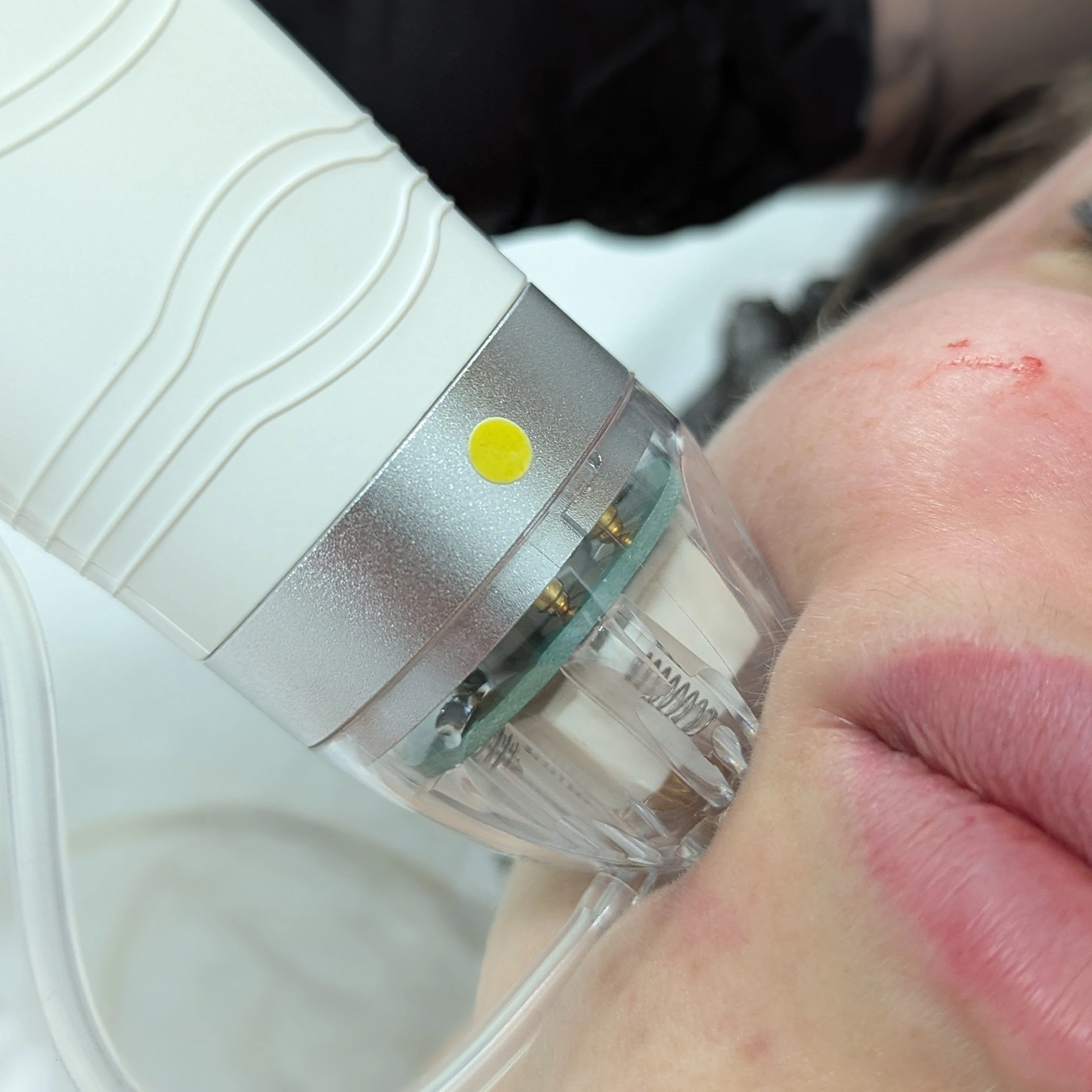 мікроголковий рф ліфтинг. Омолодження. Львів