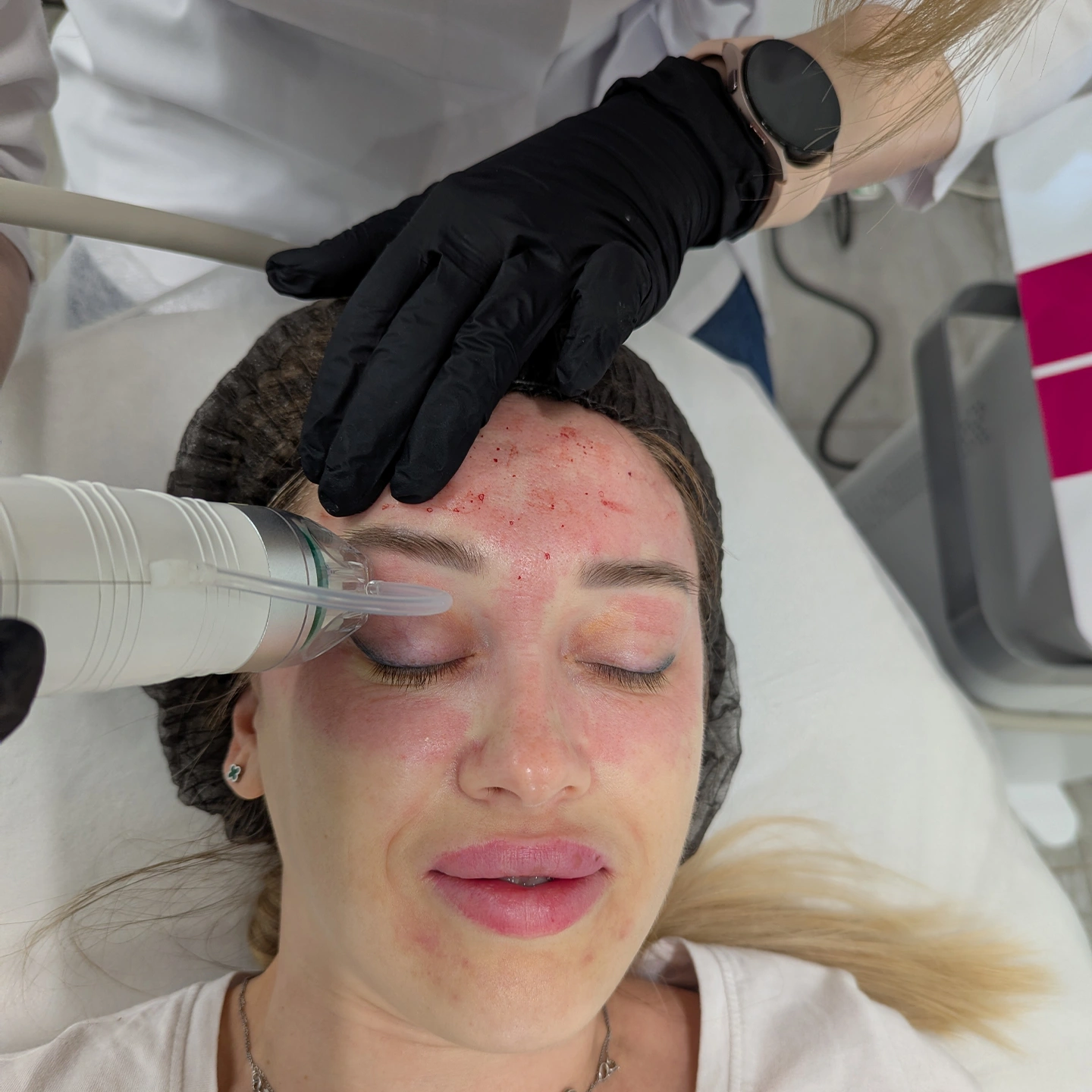 апаратне омолодження Львів. Наталія Філь. Львів