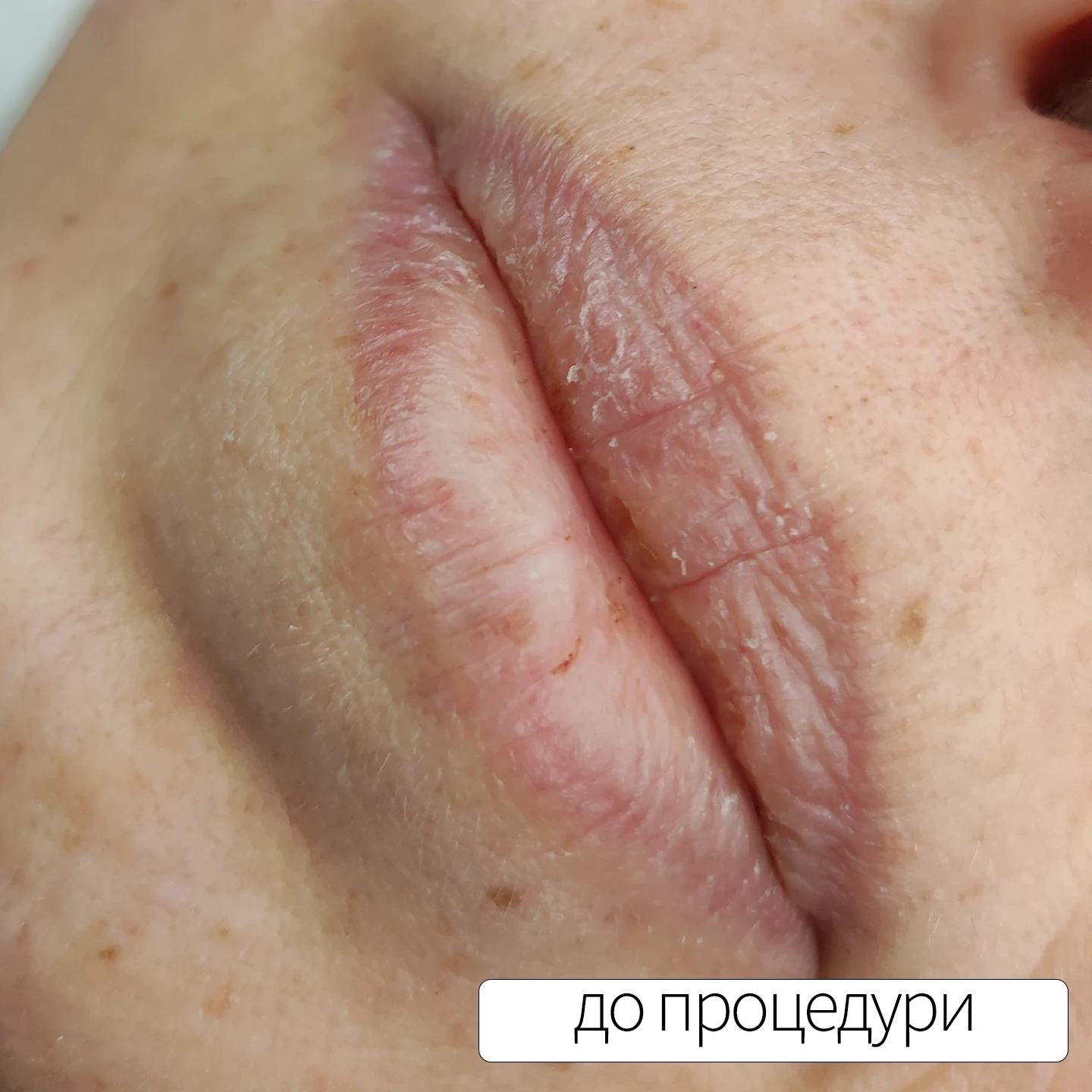 татуаж губ: До процедури татуажу. Львів