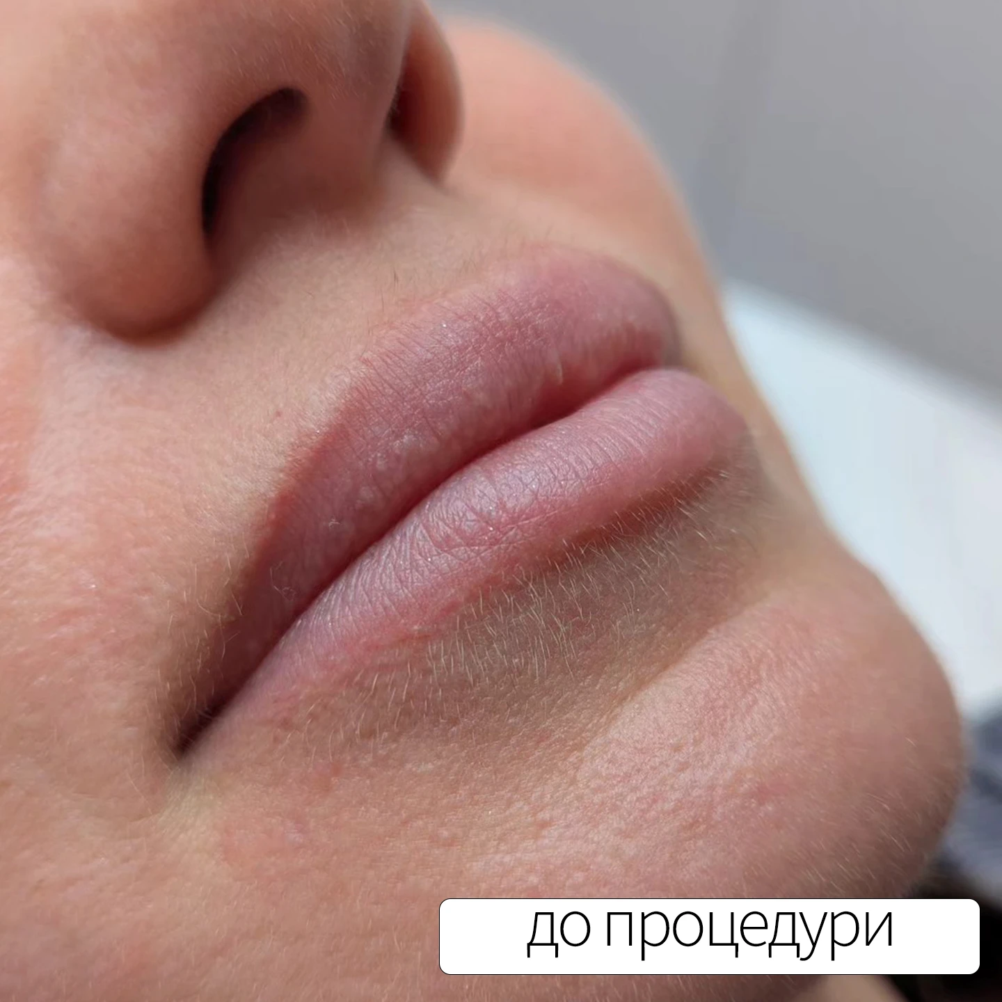 До процедури татуажу губ. Львів
