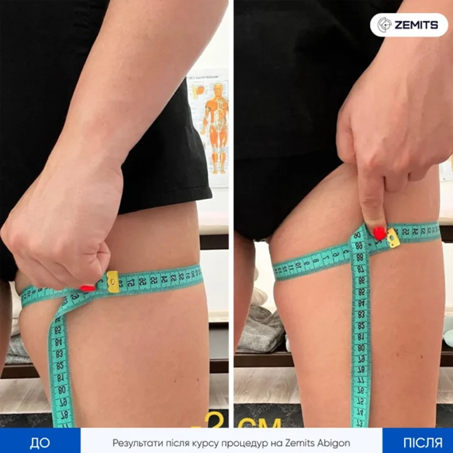 Результат рф ліфтингу. Львів