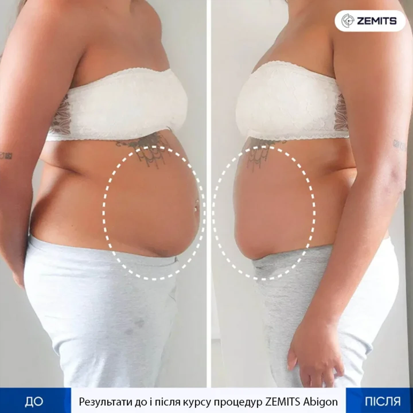 Результат rf ліфтингу. Львів