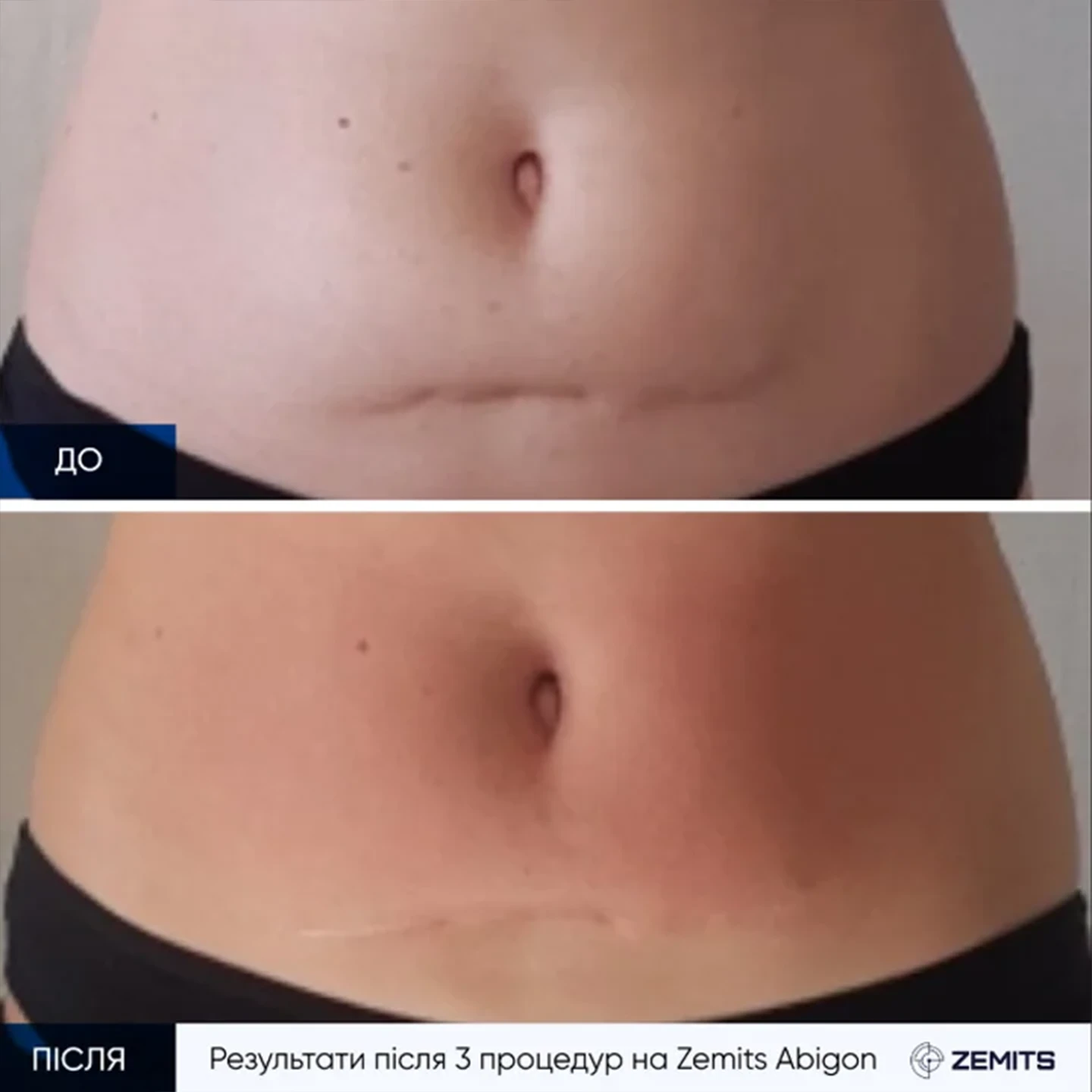 rf ліфтинг у Львів